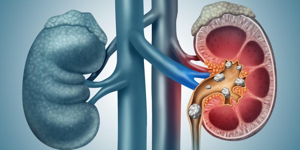 Kidney Stones Exposed