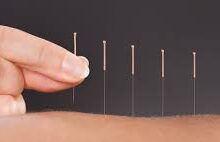 The Benefits of Acupuncture in Berkeley: A Path to Holistic Wellness