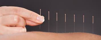 The Benefits of Acupuncture in Berkeley: A Path to Holistic Wellness