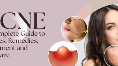 Guide to Acne Treatment