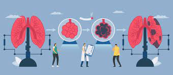 Revolutionizing Emphysema Treatment
