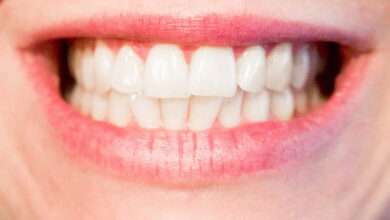 Dental Implants Service
